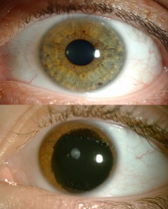 An eye affected with aniridia on the bottom compared to an unaffected eye. Click photo to enlarge