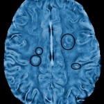 A frequency-based MRI image of an MS patient shows changes in tissue structure.