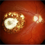 Toxoplamsa is the leading cause of infectious blindness.