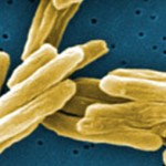 TB remains a global scourge