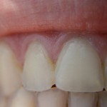 Teeth whitening can cause permanent damage: UBC prof