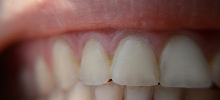 How long does it take to whiten teeth with toothpaste Teeth Whitening Can Cause Permanent Damage Ubc Prof